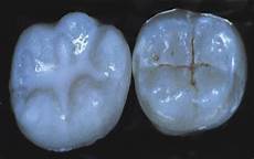 White Sealants