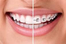 White Sealants