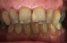 White Sealants